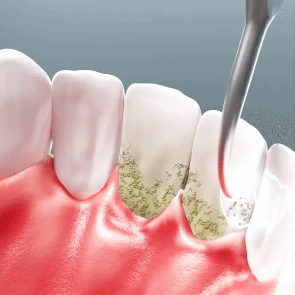 Can an Ultrasonic Tooth Cleaner Damage Enamel or Gums? | SmileAura