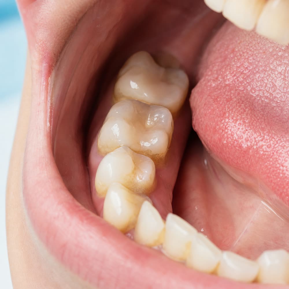 Close-up showing plaque buildup and staining on teeth